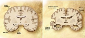 Comparación entre un cerebro normal y uno afectado de Alzheimer