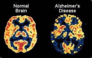 Alzheimers-Disease-342x216